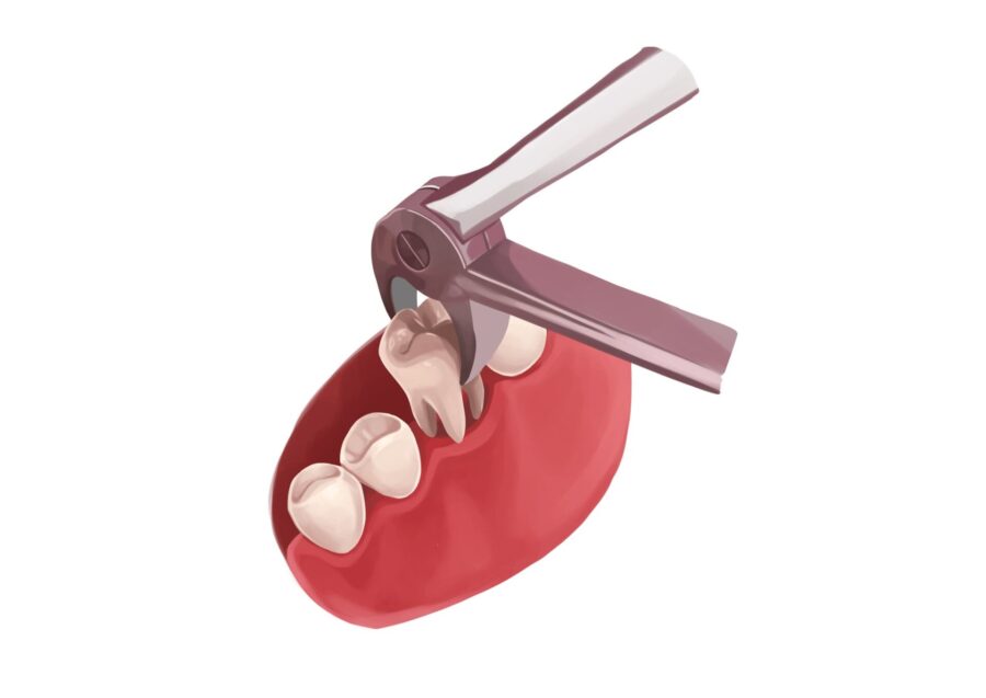 Illustration of a tooth being extracted with a special dental tool