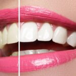 teeth whitening, teeth whitening myths, enamel damage, professional teeth whitening, in-office whitening, over-the-counter whitening, Main Street Dental, Bentonville AR, dental care, oral hygiene