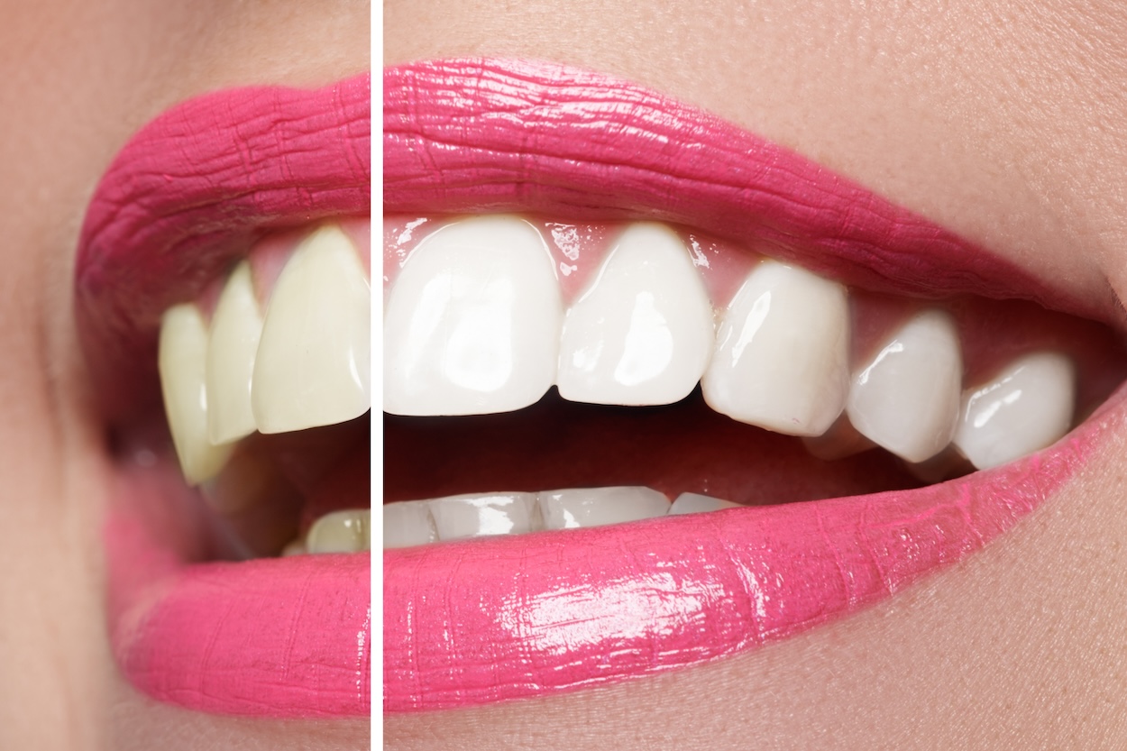 teeth whitening, teeth whitening myths, enamel damage, professional teeth whitening, in-office whitening, over-the-counter whitening, Main Street Dental, Bentonville AR, dental care, oral hygiene