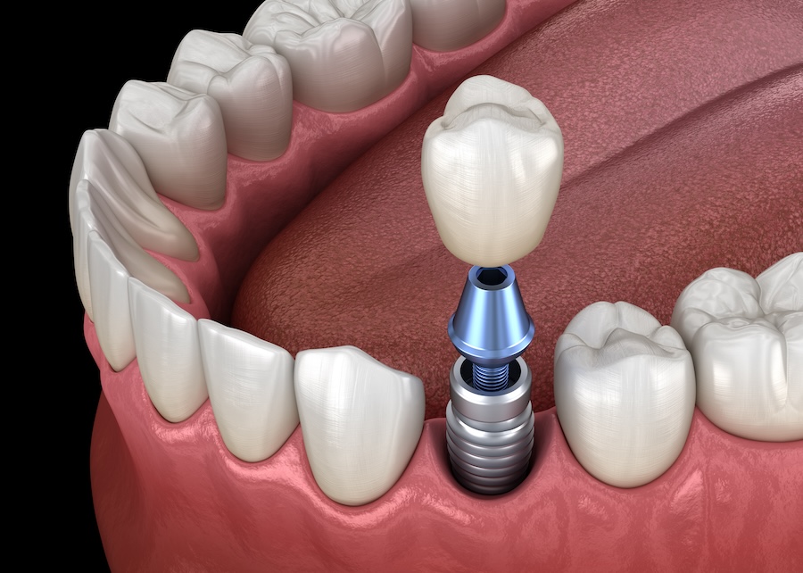 dental implants, dental implant care, Main Street Dental, Bentonville dentist, Dr. Sydney Henderson, Dr. Jeffrey A. Evans, oral hygiene, implant maintenance, dental check-ups, gum disease prevention