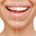 should you get dental veneers, woman with dental veneers