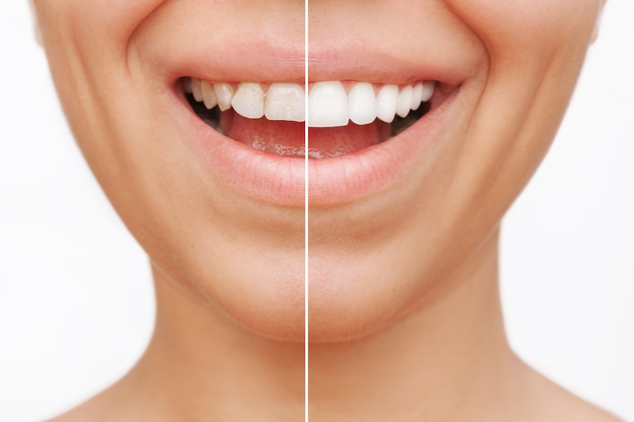 should you get dental veneers, woman with dental veneers